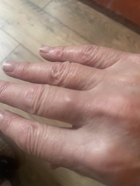 Stick a needle in this lump??