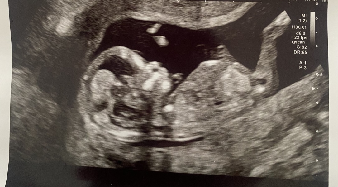 Nub theory- Can anyone see the nub? 13 wks
