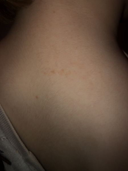 Tiny mark that doesn’t disappear on toddlers neck