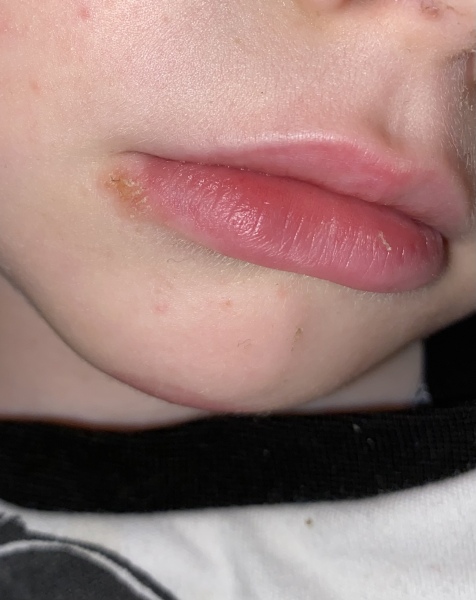 Help! Is this a cold sore