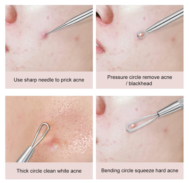 Deep blackhead on DS's forehead. Ideas for removal