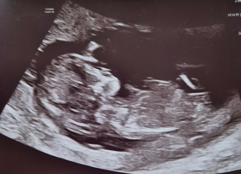Just for fun - nub theory - boy or girl?