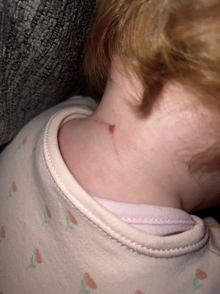 Mark on back of toddlers neck