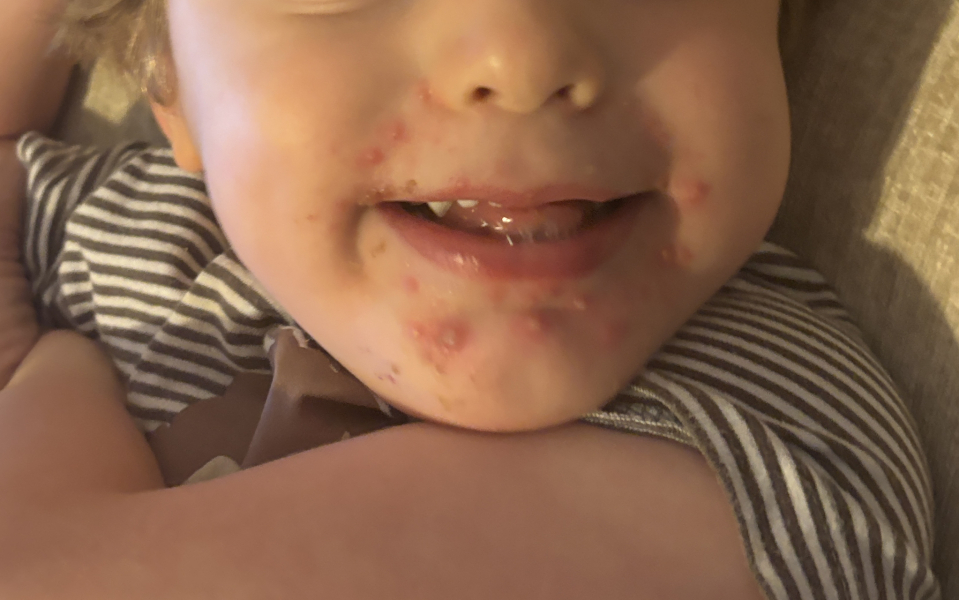 Possible pox and children's party!