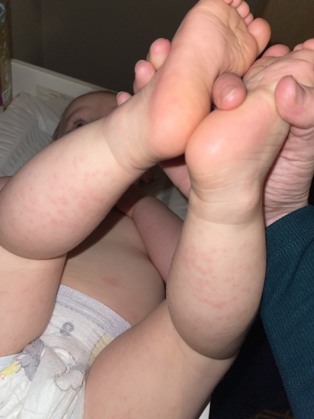 15 month old with rash on back of legs