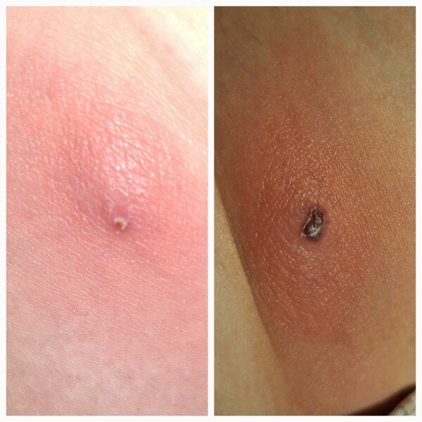 Pics - Skin abscess/boil? Someone please advise 😣