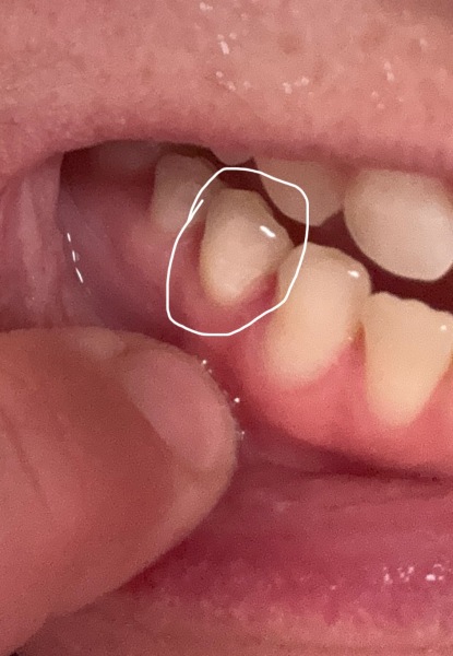 Cut on gums