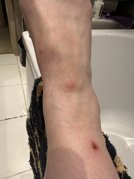 Mosquito bites late November?