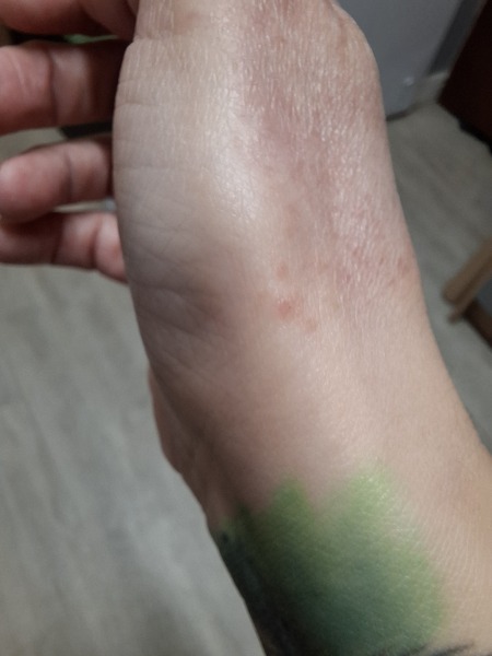 Hand infected (Warning, gross photos)