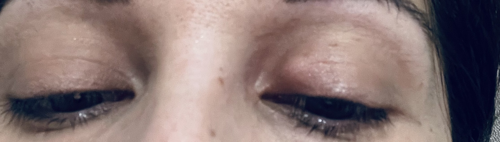 Stye ?