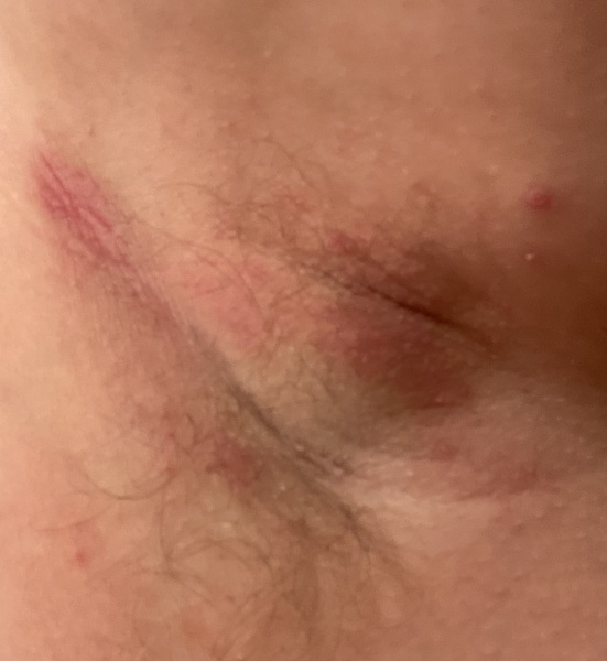 What is this in my armpit? Sorry, slightly gross photo.