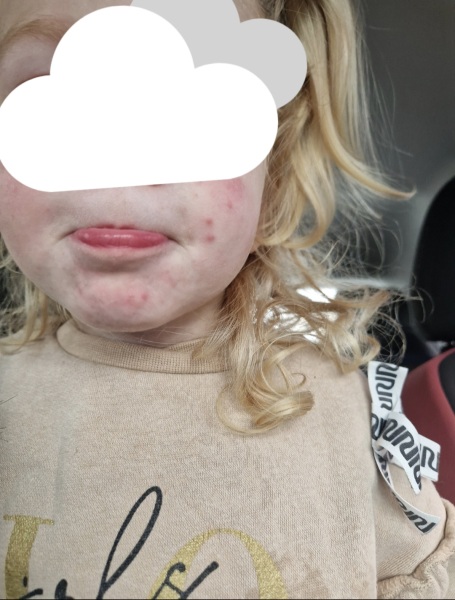 Is this the start of chicken pox / hand foot & mouth ?