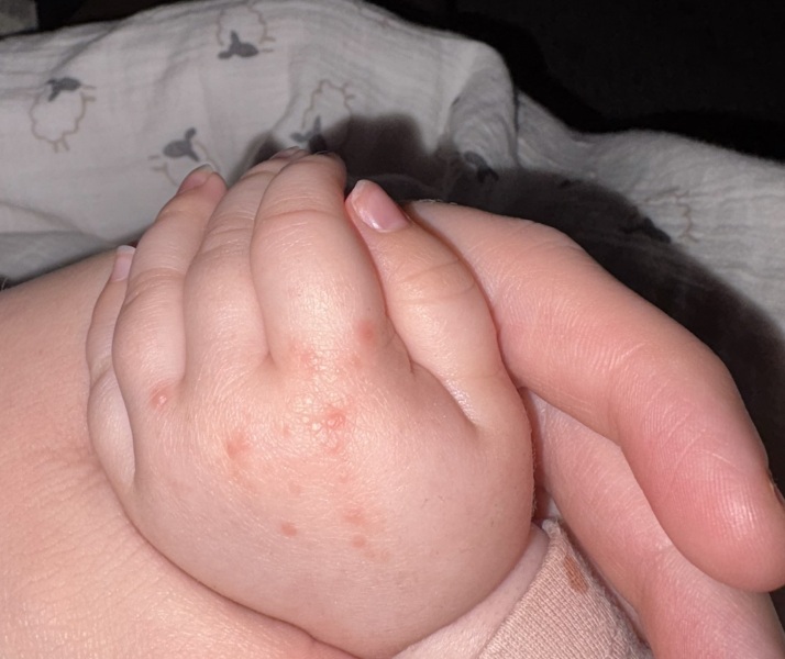 Hands foot and mouth