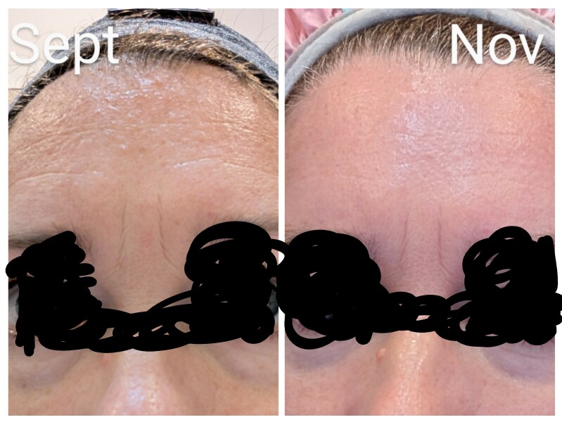 Deep forehead wrinkles