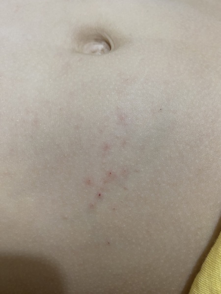 Is this a scabies rash or something else?(photos included)