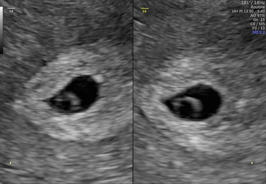 5 weeks 4 days  no fetal pole