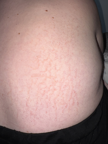 Sore rash/marks on back (photos)