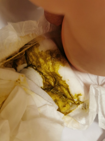 Dairy intolerant? Warning of poo pic!