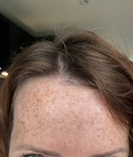 Tretinoin 0.006 - I think I can see an improvement already!! (Pic)