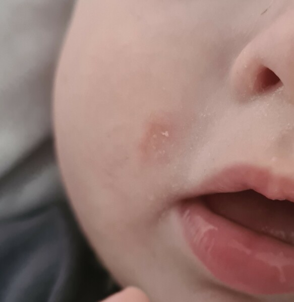 8 month old has this red mark?