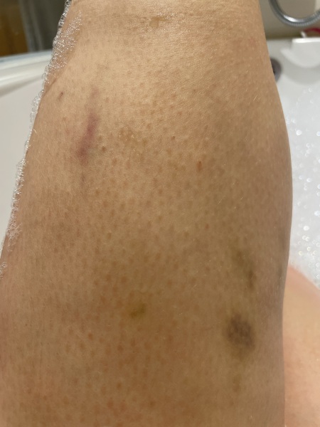 Excess bruising? Am I just a peach?