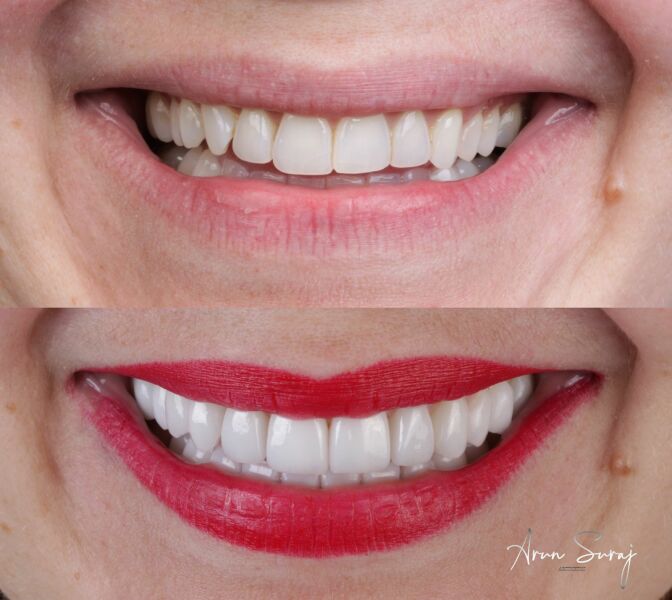 Has anyone had cosmetic dentistry?