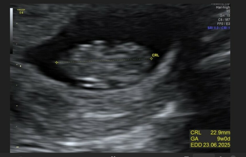 9wk early scan