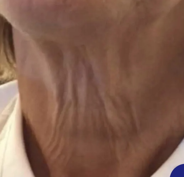 The dreaded turkey neck