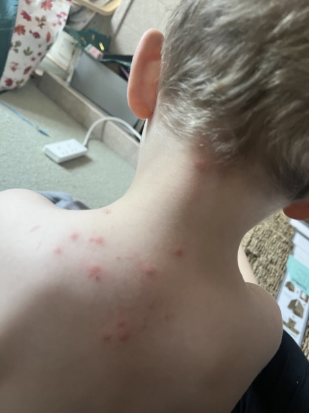 Chicken pox?
