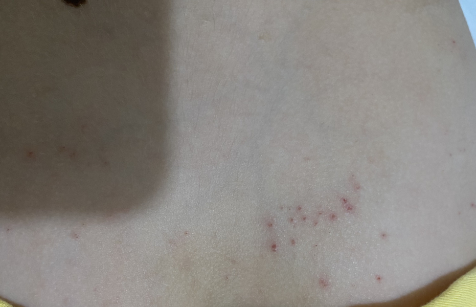 Is this a scabies rash or something else?(photos included)