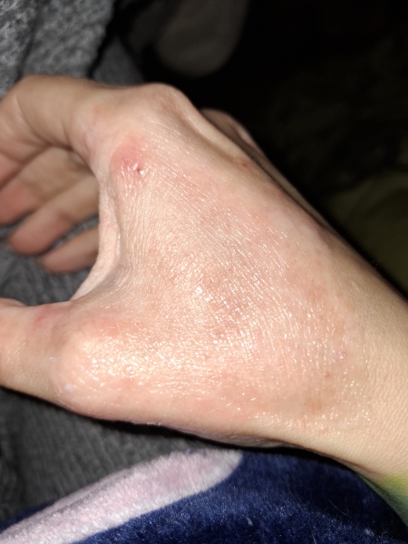 Hand infected (Warning, gross photos)