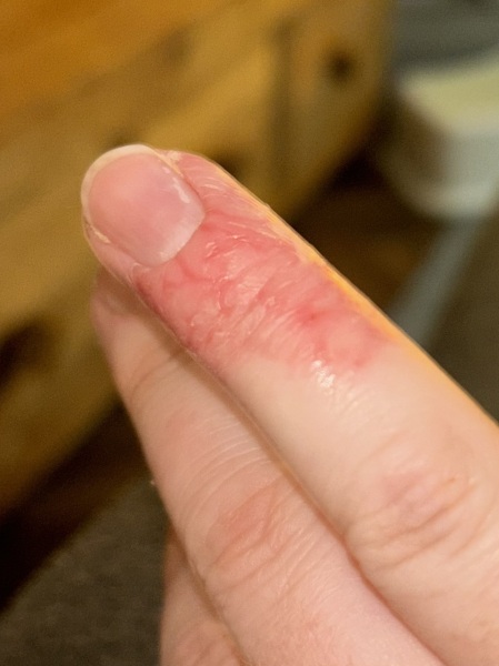 What is this on my finger?