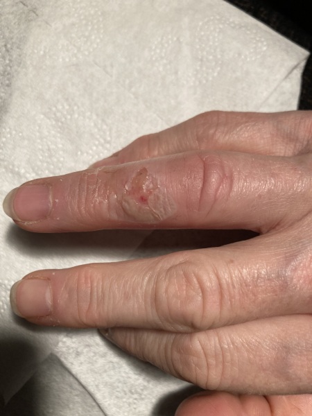 What am I supposed to do with this? Burnt finger; pic included