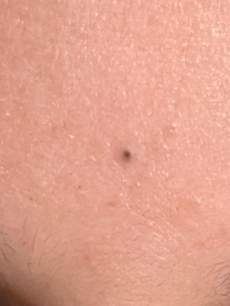 Deep blackhead on DS's forehead. Ideas for removal