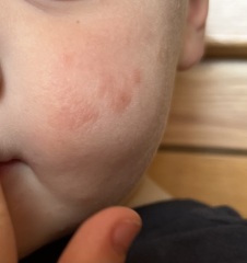 Recurring red marks on 2 year olds face