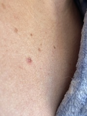 Strange mole