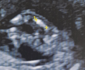 Guess the gender: boy or swollen girl.