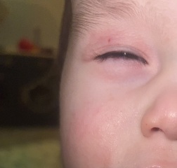Anyone eczema experiences? Eyelid / pictures including