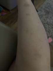 Bruising