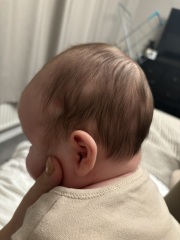 Baby bald patches