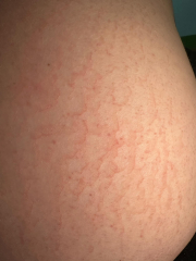 Sore rash/marks on back (photos)