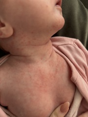 5 week old, Is this baby acne?