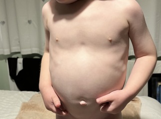 Bloated tummy in toddler.