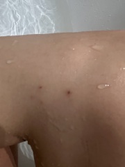Is this Scabies…?