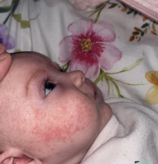 Neocate rash?