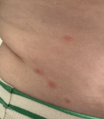 Is this Chicken Pox or more serious?