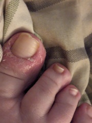 What cream to use on this ore toe ?