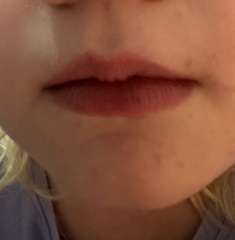 Could anyone advise what this rash could be please?