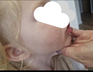 Is this the start of chicken pox / hand foot & mouth ?
