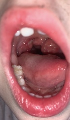 Tonsils picture please help!